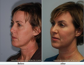 laser_facelift_ba