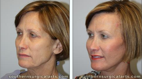 Facelift_before_after