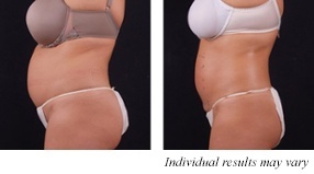 Exilis Before and After