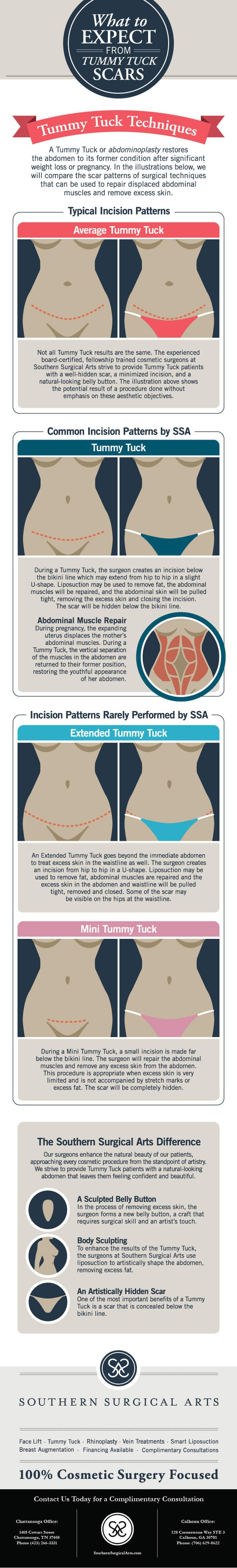 19_SSA_What-to-Expect-From-Tummy-Tuck-Scars_Update-01