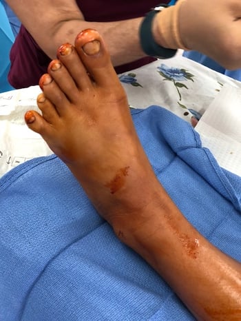 Foot with congenital birth defect pre-op