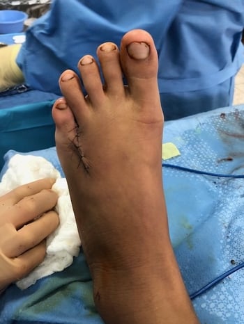 Post-op photo of foot after removal of 6th toe