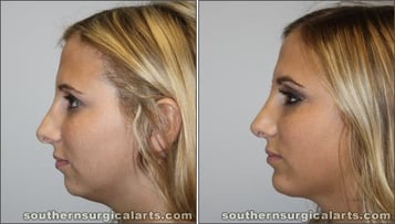 chin-implant-before-after