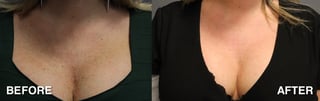 Before and after 1 IPL Treatment courtesy of Tammy Capel, Aesthetician
