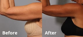 BodyTite-before-and-after.jpg