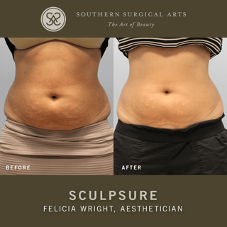 ssa-before-and-after-sculpsure-2.png